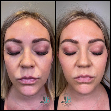 Before & After | Beautiphi Asthetic boutique | Rochester Hills, MI 48309, United States