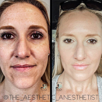 Before & After | Beautiphi Aesthetic boutique | Rochester Hills, MI 48309, United States