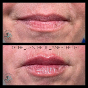 Before & After | Beautiphi Aesthetic boutique | Rochester Hills, MI 48309, United